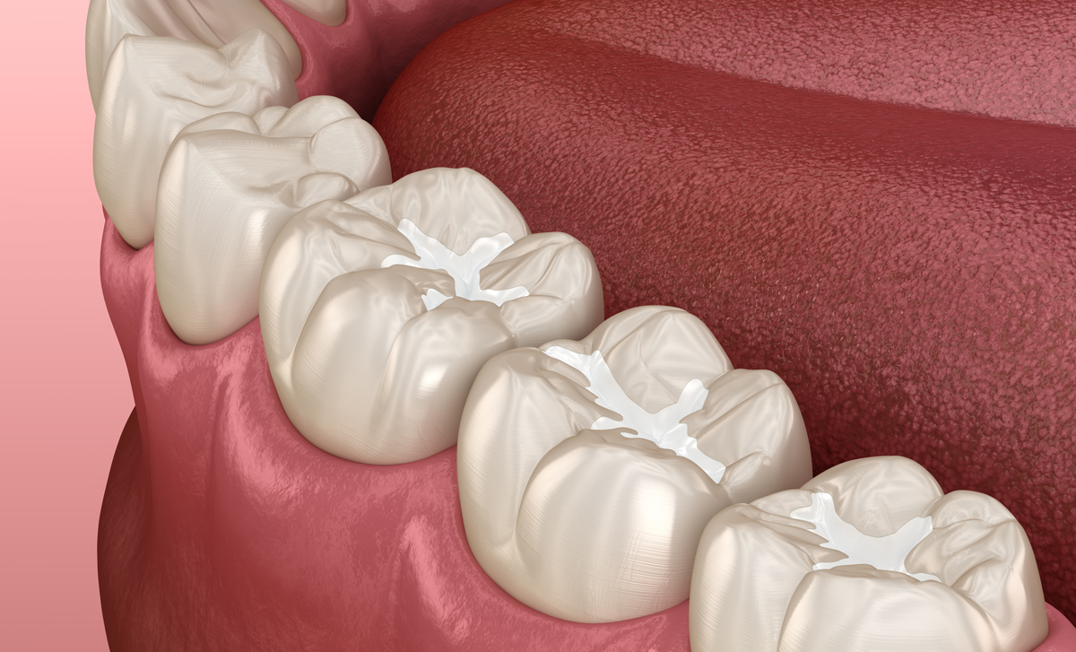 teeth with sealants