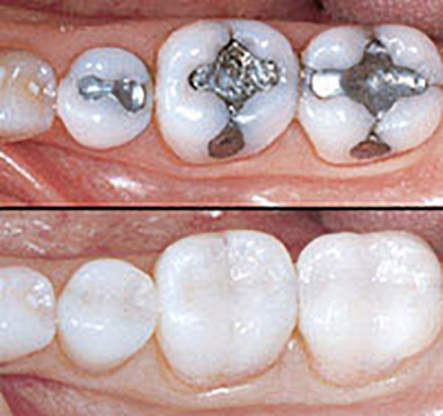 Before and after tooth coloured fillings.