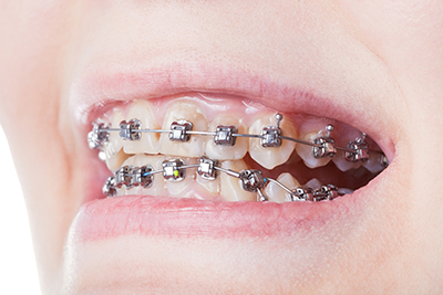 a smile with advanced metal braces.