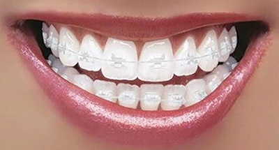 A smile with ceramic braces.