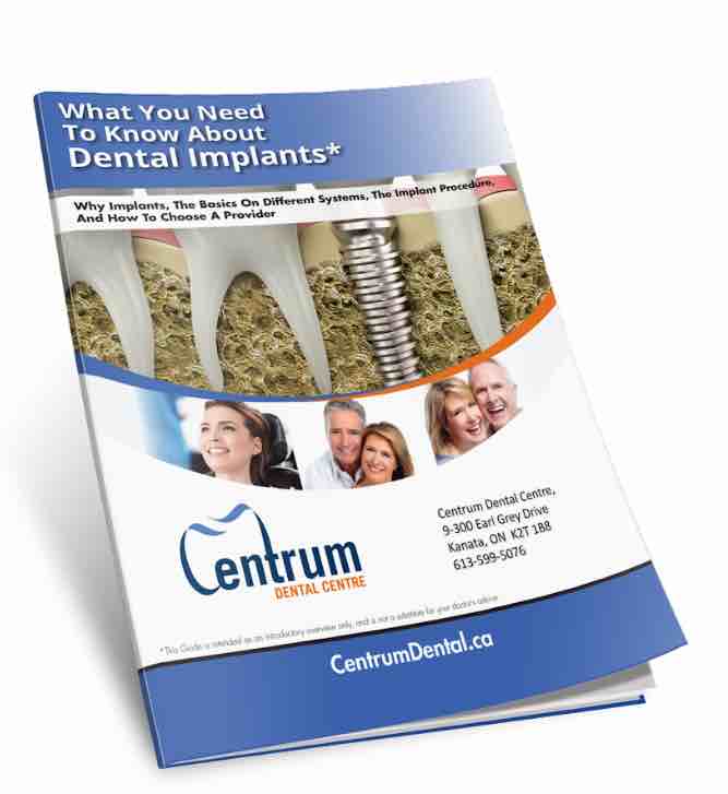 our free dental implants guide