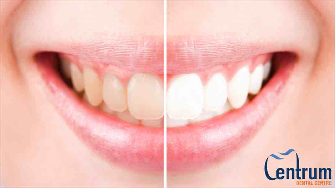 teeth showing discoloured on one side and white on the other.