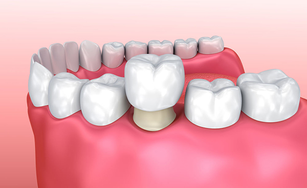 A illustration of a dental crown.