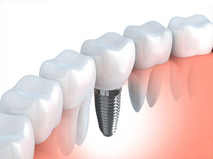 An illustration of a dental implant.