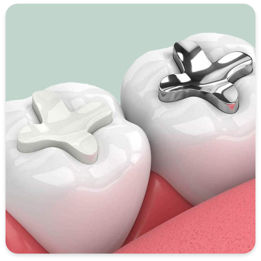 Tooth-coloured fillings
