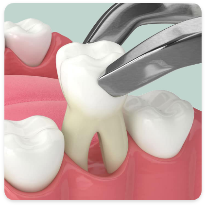 Extractions (including wisdom teeth)