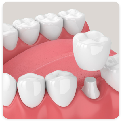 Porcelain Crowns