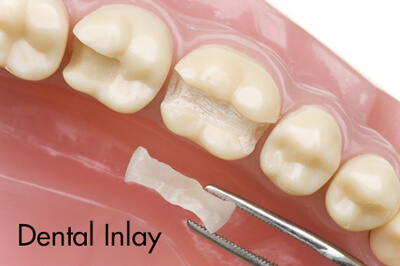 Teeth illustration dental inlay