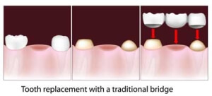 Tooth replacement illustration