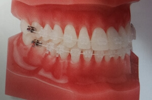 Teeth with braces