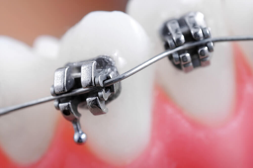 Teeth braces