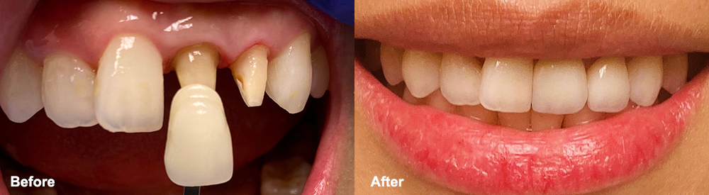 Before: On the left the tooth is narrow and worn down. After: Perfect smile!