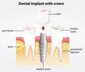 A diagram of showing the implant screen fitted in the jaw.