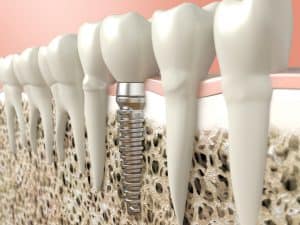 A graphic of dental implants