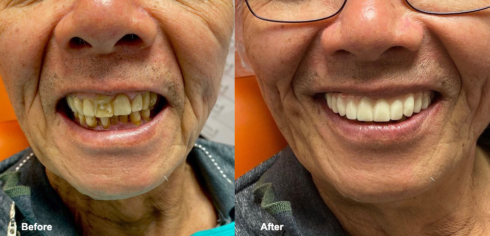 Before: The patient's teeth look very worn down and discoloured. After: Perfect smile!