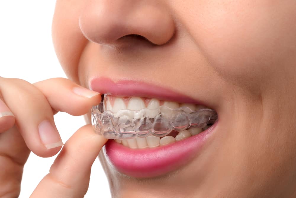 A close up of Invisalign being inserted.