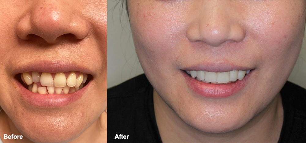 Before: Teeth are crooked. After: Perfect smile!