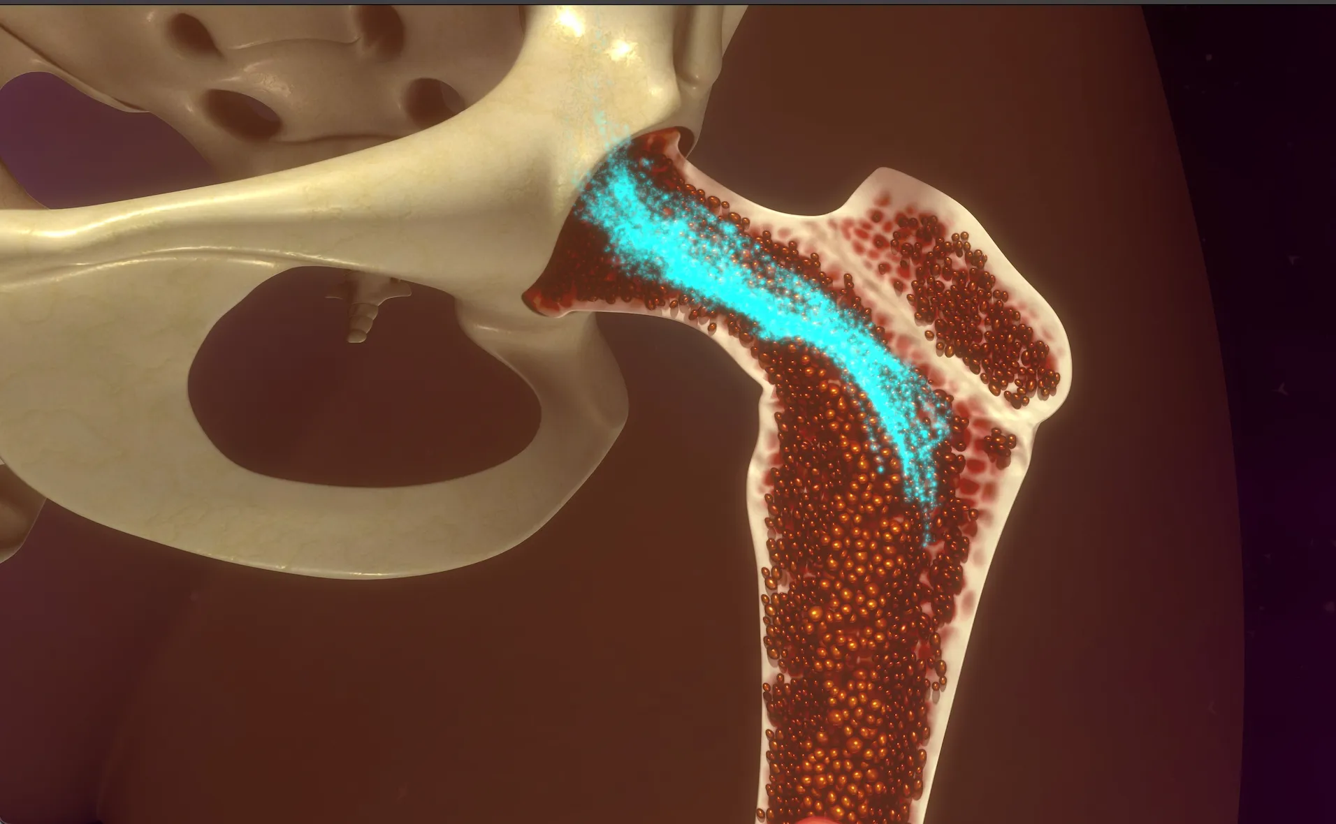 Аутотрансплантация костного мозга. Аутотрансплантация костного мозга. Трансплантация гемопоэтических стволовых клеток. Рак пересадка костного мозга. Трансплантация гемопоэтических стволовых клеток.