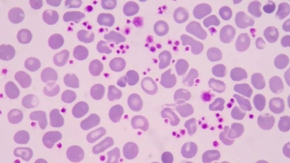What is Thrombocytopenia in Myeloma? - HealthTree for Multiple Myeloma