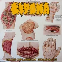 Chronic Inflammatory Dermatopathy - Lipoma