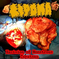Excision of Monstrous Teratoma - Lipoma