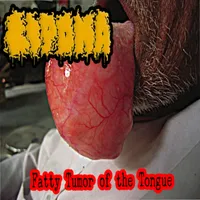 Fatty Tumor of the Tongue - Lipoma