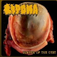 Slayer of the Cyst - Lipoma