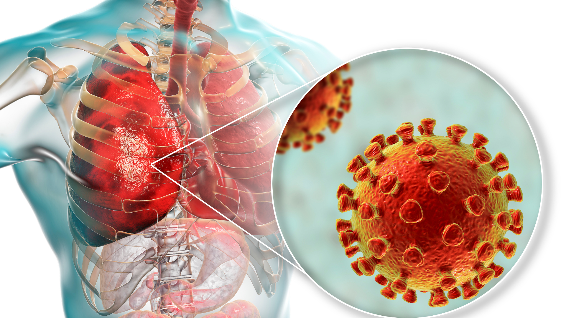 What Is a Respiratory Pathogen Panel? How multiplex PCR helps detect dozens of viruses and bacteria at once.