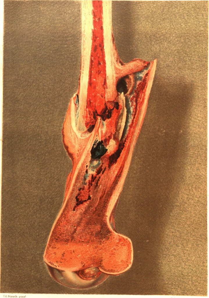 Femur Osteomyelitis, 1883 (Internet Archive)