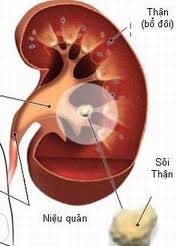 4 nguyên nhân gây sỏi thận