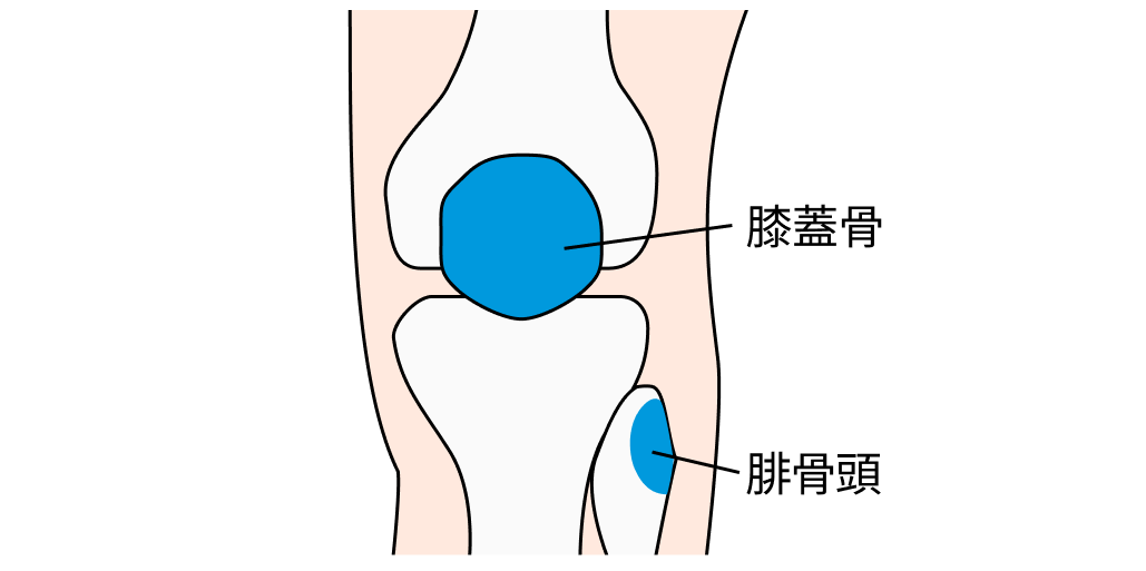 【膝外傷】オタワ膝外傷ルールとPittsburgh膝ルールの比較「レントゲン必要？」