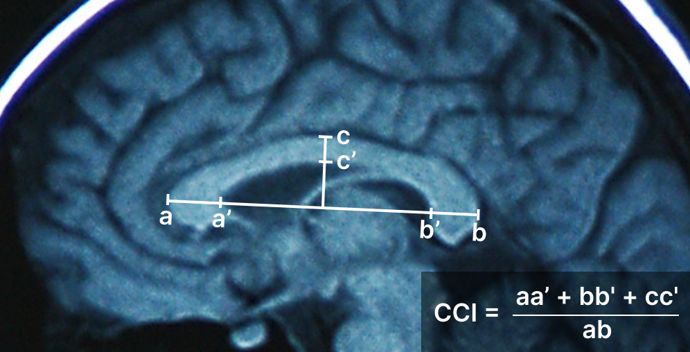 脳梁インデックス (CCI)