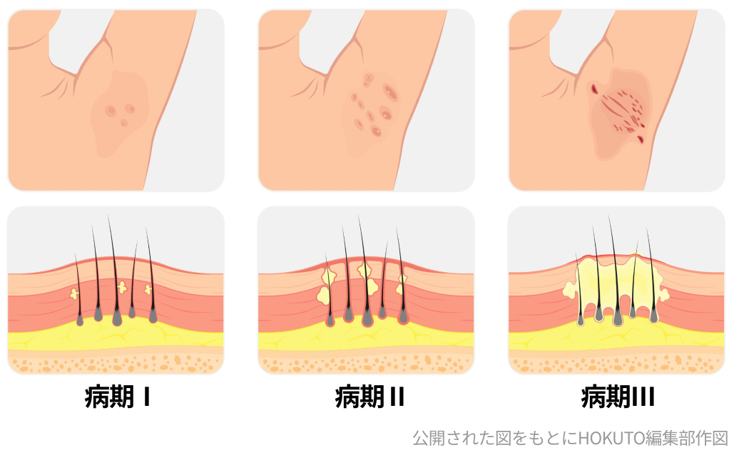 Hurley病期分類