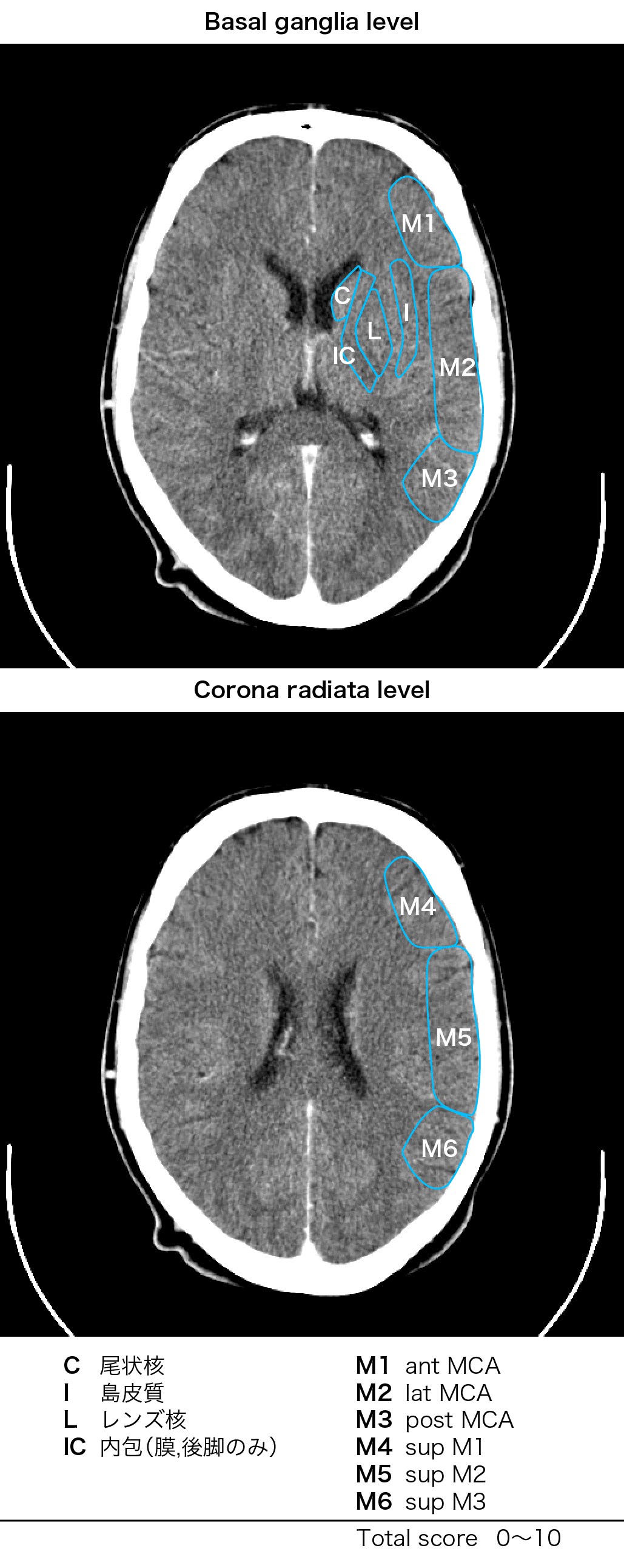 【ASPECTSスコア】急性期脳梗塞の頭部CT定量評価方法
