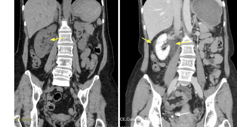 【画像診断】尿路結石の特徴的所見とは？水腎症､水尿管症､周囲脂肪組織混濁など