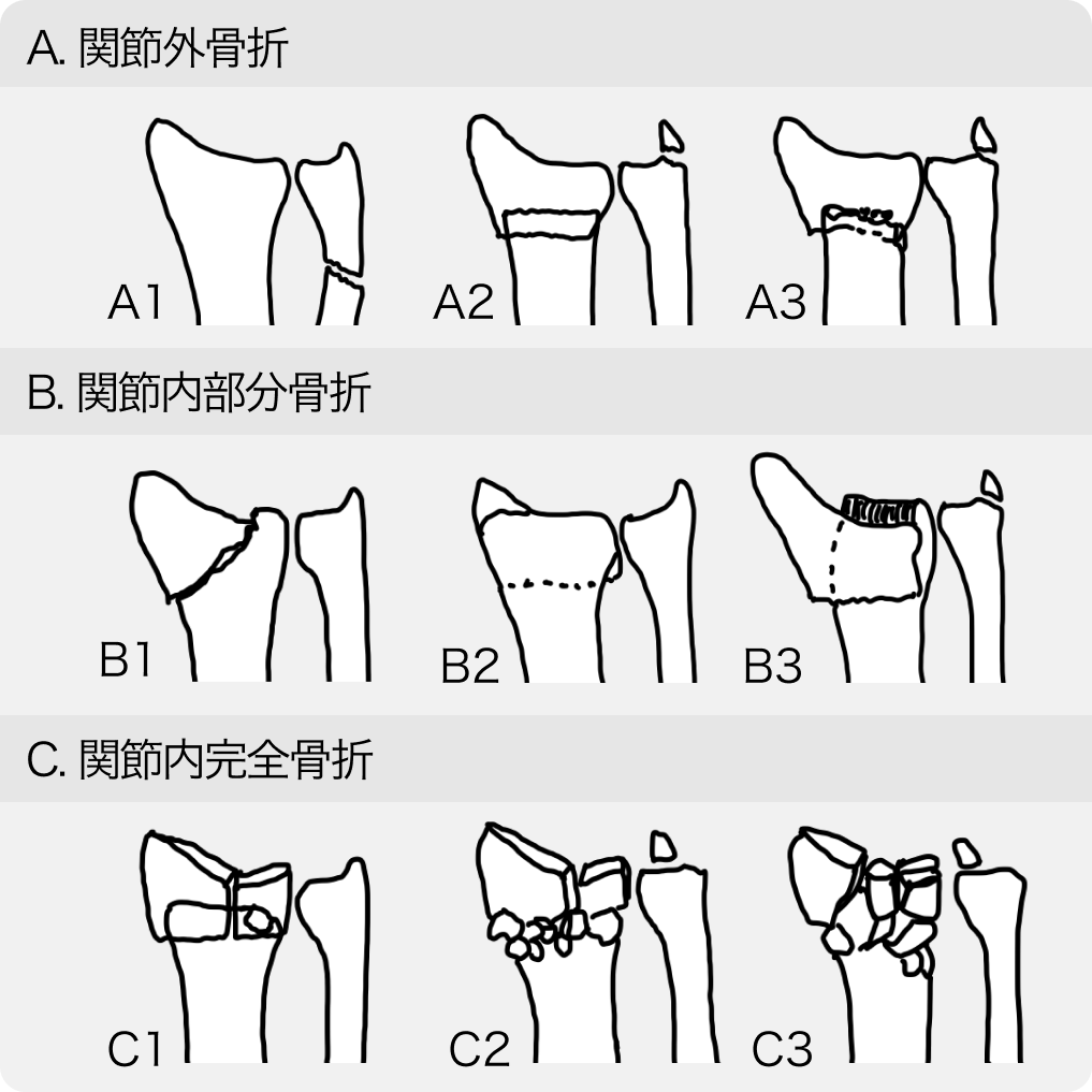 橈骨遠位端骨折