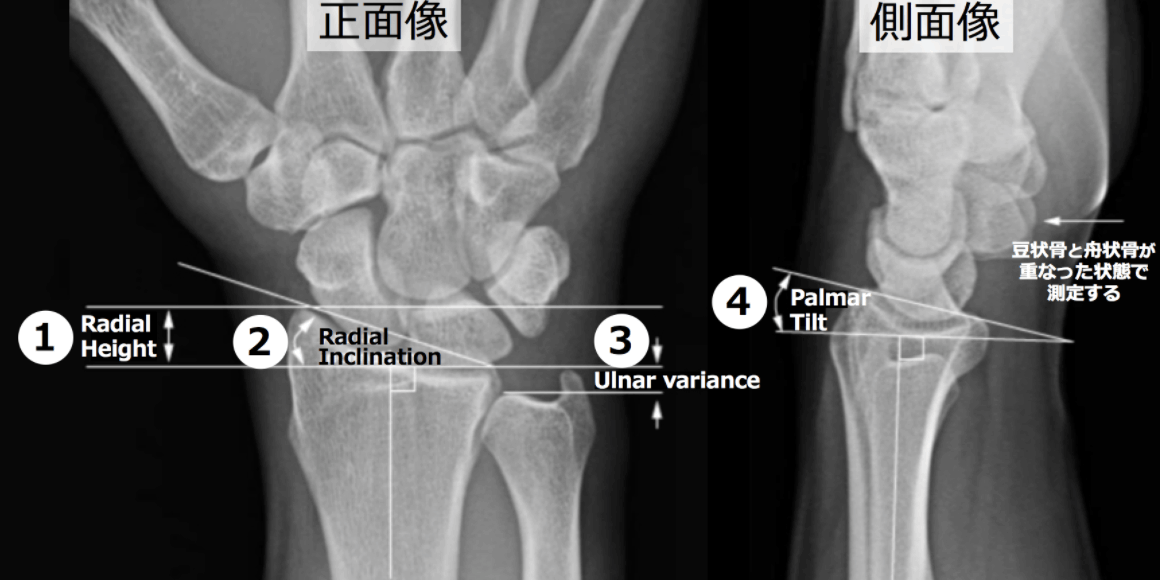 橈骨遠位端骨折