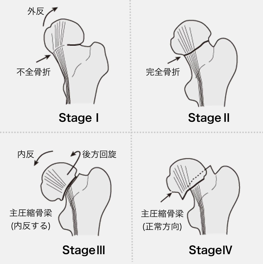 大腿骨近位部骨折