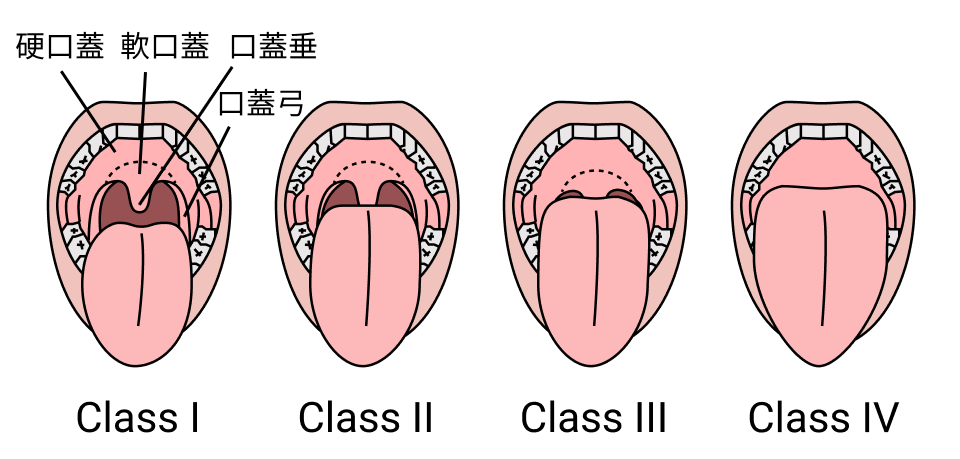 【緊急気道管理まとめ】語呂合わせやMallampati分類などのイラストを追加！