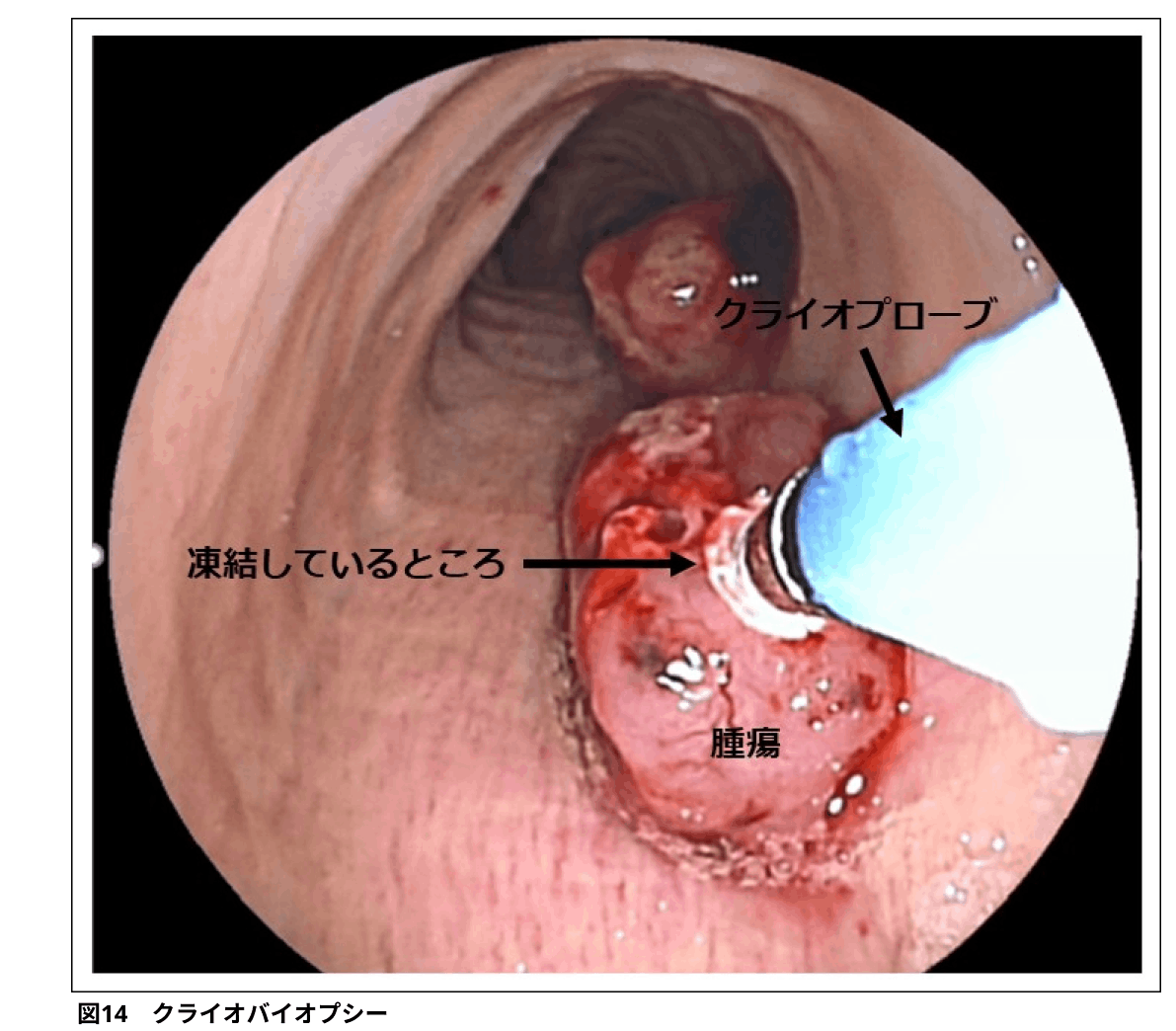 後期研修医のための呼吸器内科現場診療：｢気管支鏡｣ (日赤医療センター 出雲雄大先生)