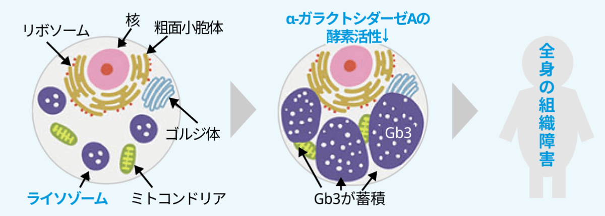 原因不明の心肥大､小児期の燃えるような四肢末端痛で想起すべき疾患 ~ファブリー病まとめ~ ¹⁾