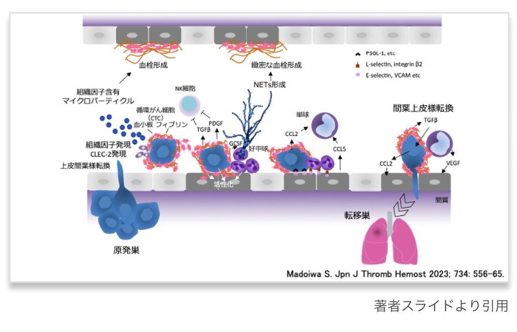 【新連載】まるわかり！がん関連静脈血栓塞栓症 (CA-VTE)