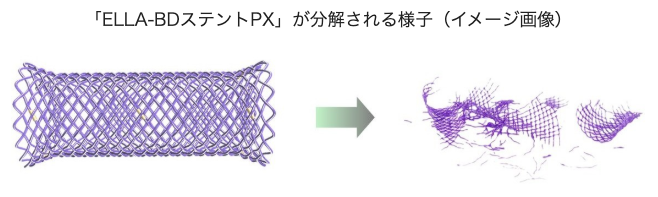 本邦初の吸収性食道用ステントが承認､ 保険適用の手続きへ