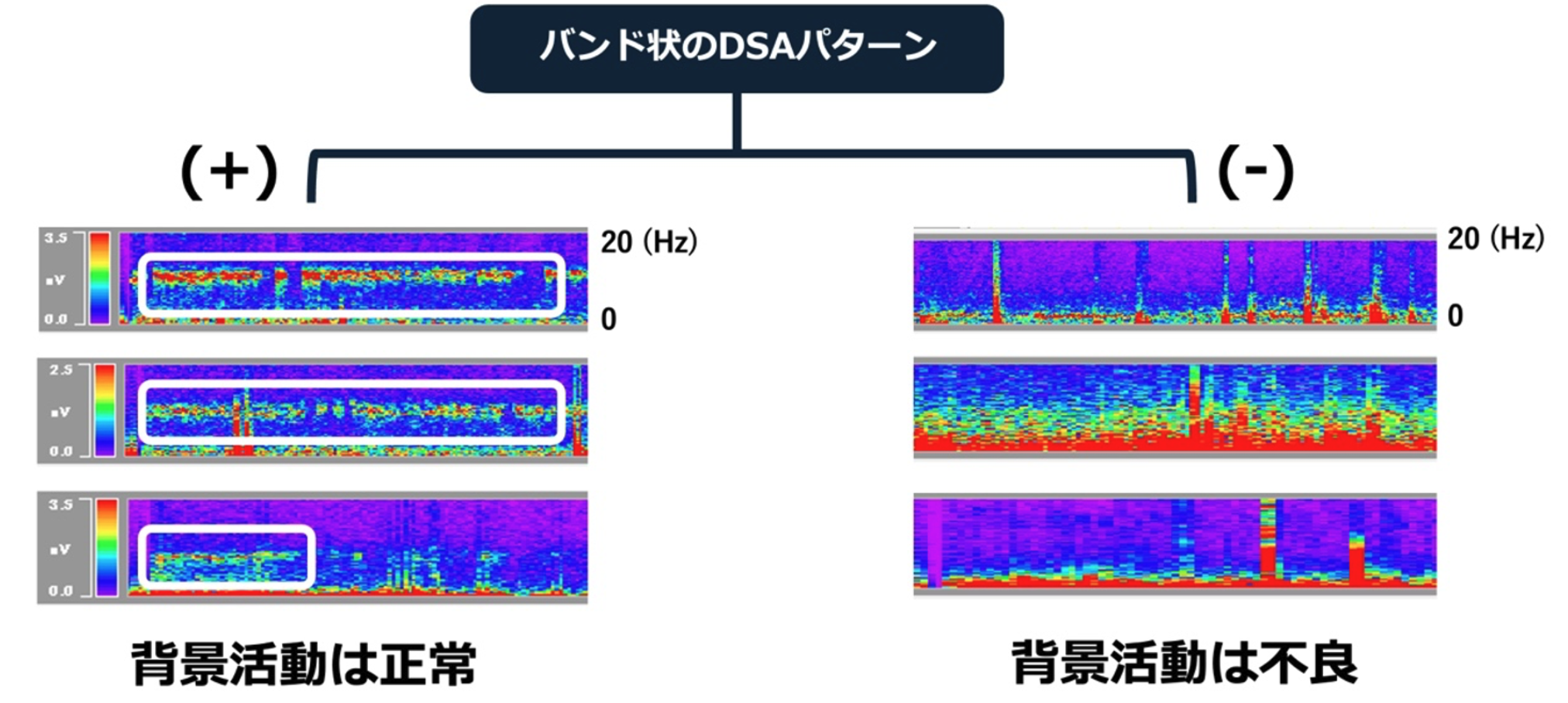 【新連載】急性期脳波の判読方法のポイントは？