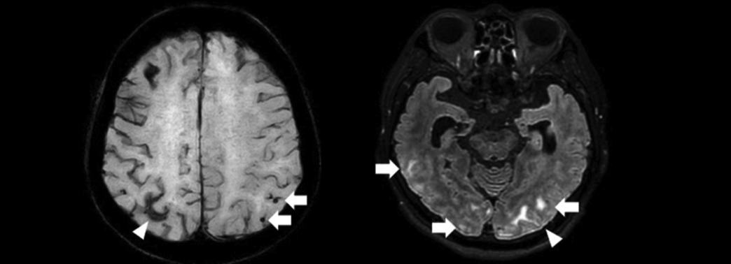 【注目記事まとめ】アルツハイマー病  (カレントテラピー)