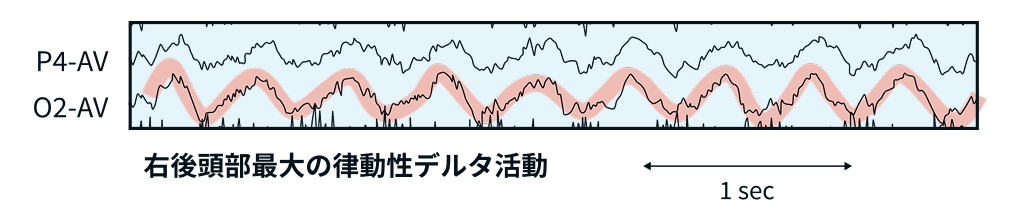 【脳波クイズ】パーキンソン病の低血糖発作､ 意識障害の原因は？