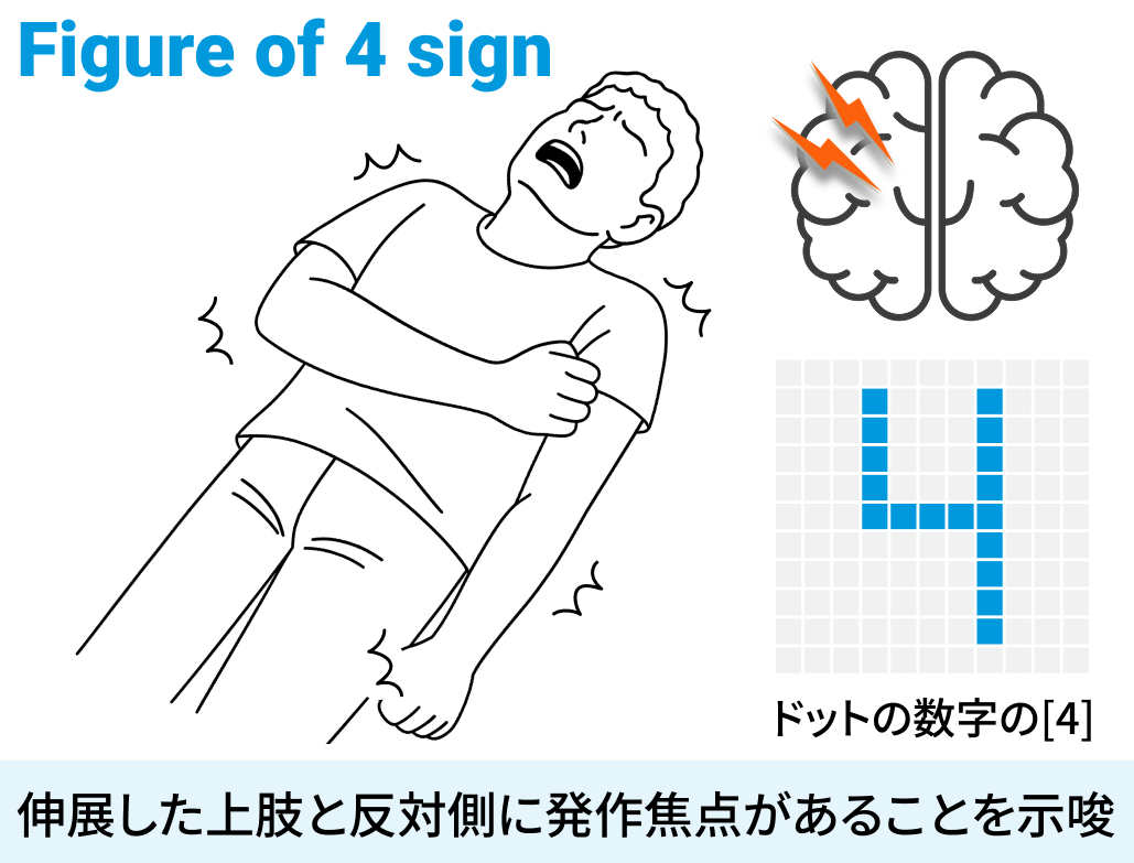 【けいれん】遭遇した発作のチェックポイント : 発作症候学 (音成秀一郎先生)