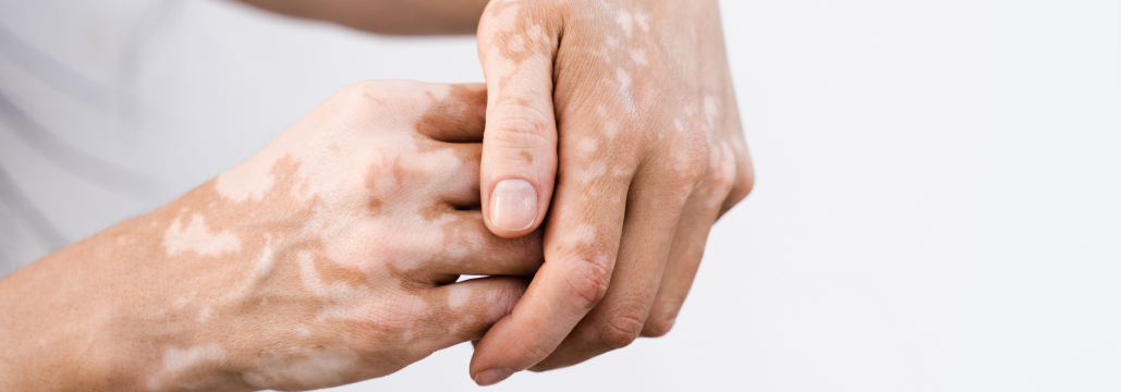 【JAMA Dermatol】白斑にバリシチニブ＋ナローバンドUVB療法が有効