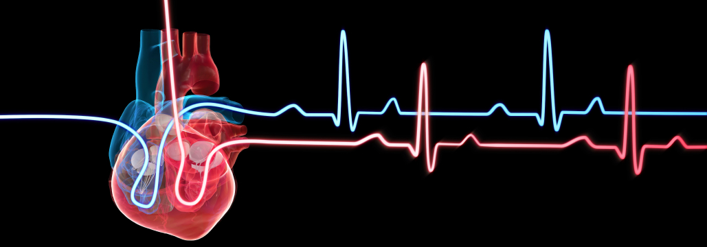 【NEJM】PCI後1ヵ月でアスピリン中止 : 低リスクAMIでDAPT継続に非劣性