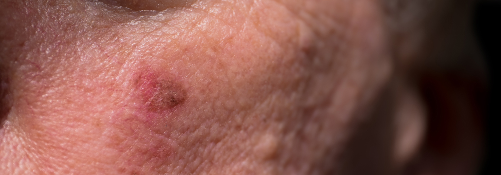 【JAMA Dermatol】ニコチンアミドの皮膚癌予防、 初回発症後の服用で効果最大化